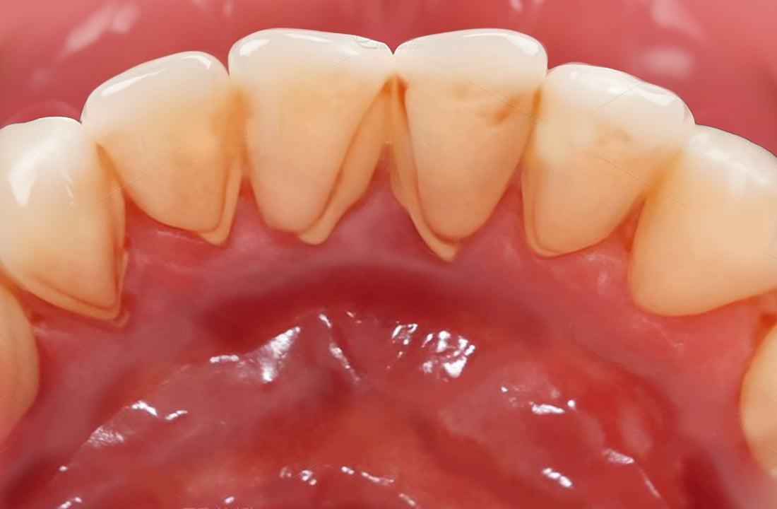 What Happens If You Don’t Brush Your Teeth Properly?